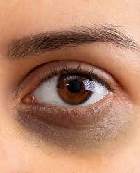 Under eye circles 